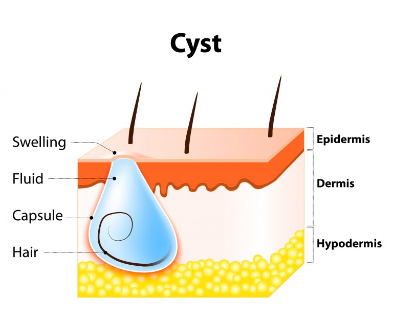 Cysts