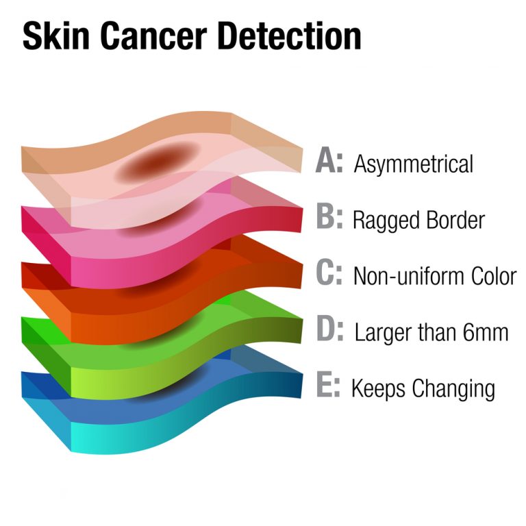 Skin Cancer Screening Removal And Treatment